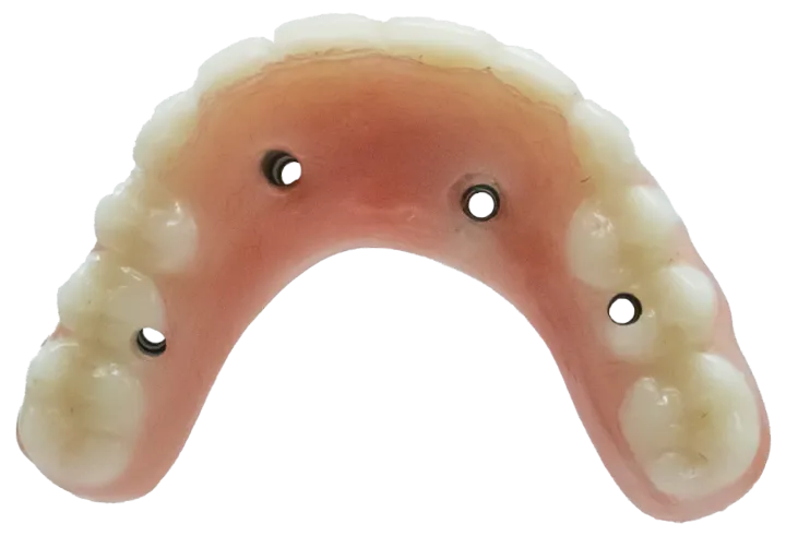 Mouth with holes from traditional dental implants.