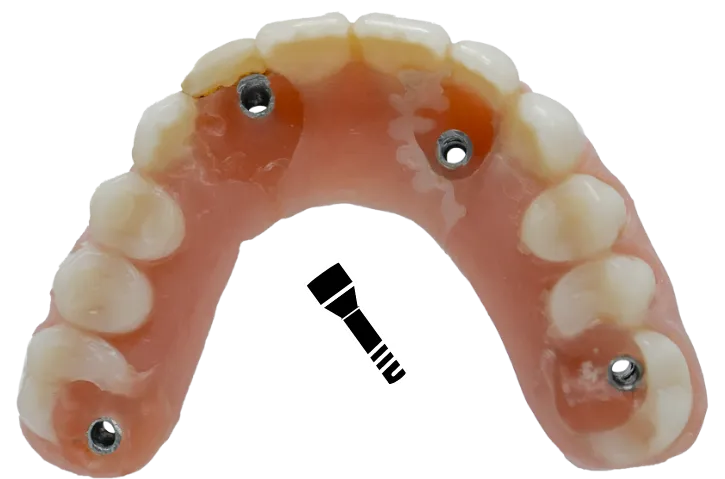 Mouth with traditional implant screws.